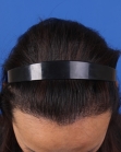 After Hair Transplant&nbsp;Hairline